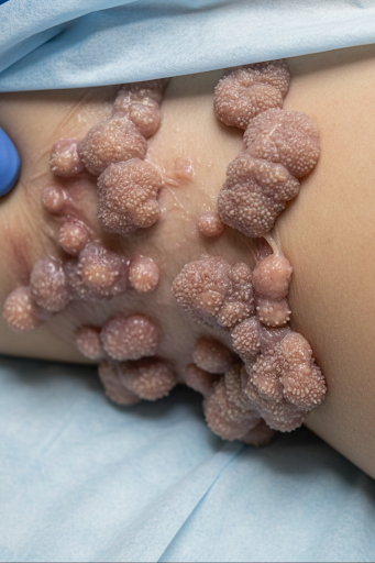 Condyloma Acuminata (Genital Warts)