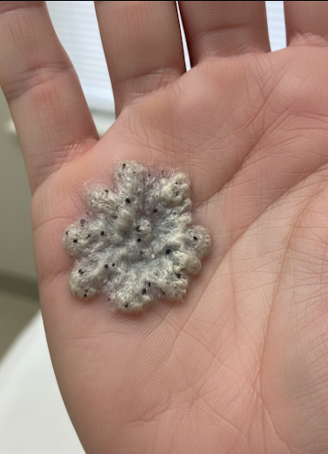 Palmoplantar Wart (Palmo-Plantar Verruca)