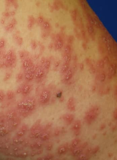 Xanthomatous Pustulosis