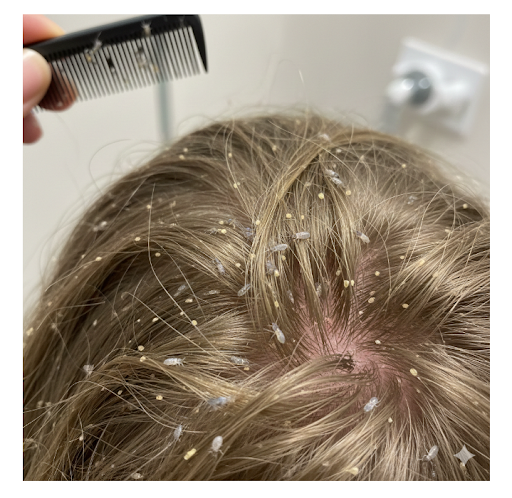 Pediculosis (Head Lice)