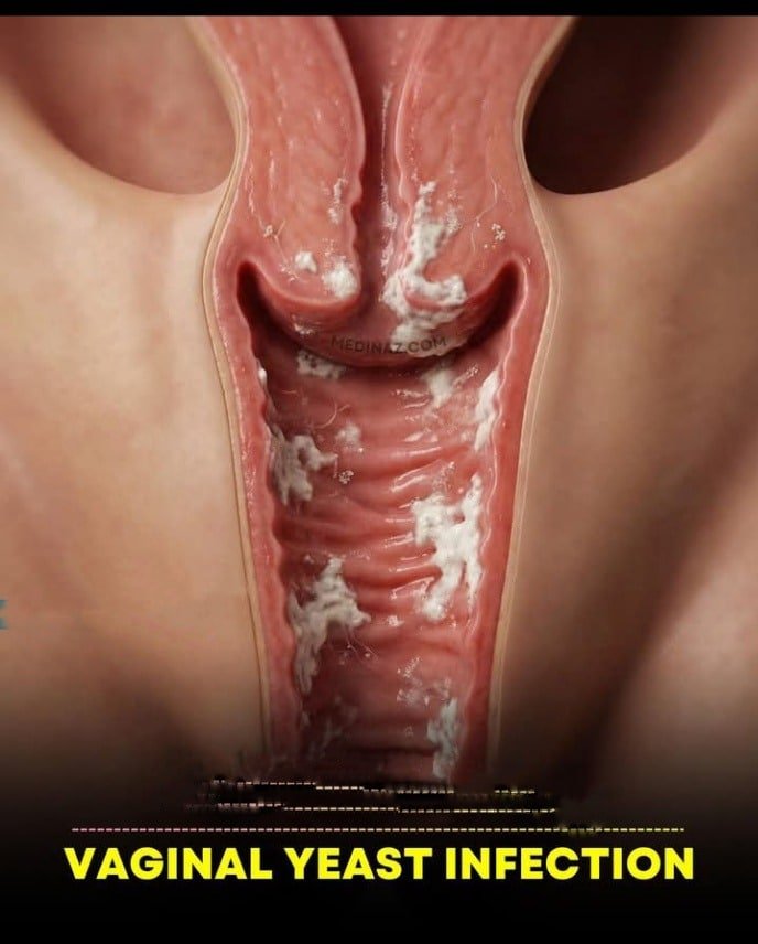 Vaginal Yeast Infection