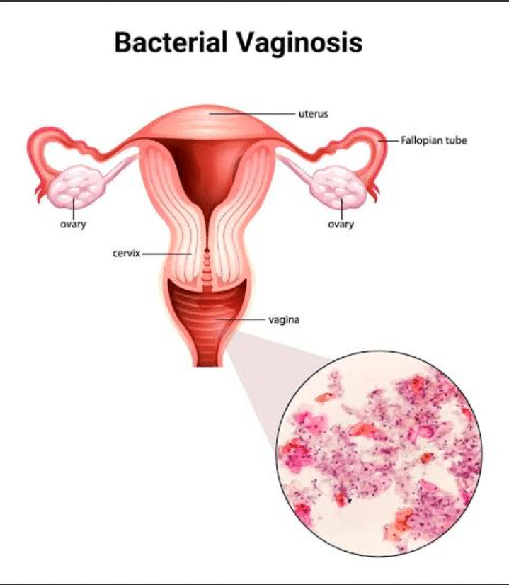 Bacterial Vaginosis (BV)