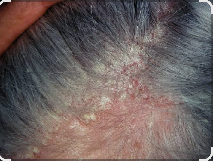 Seborrheic Dermatitis