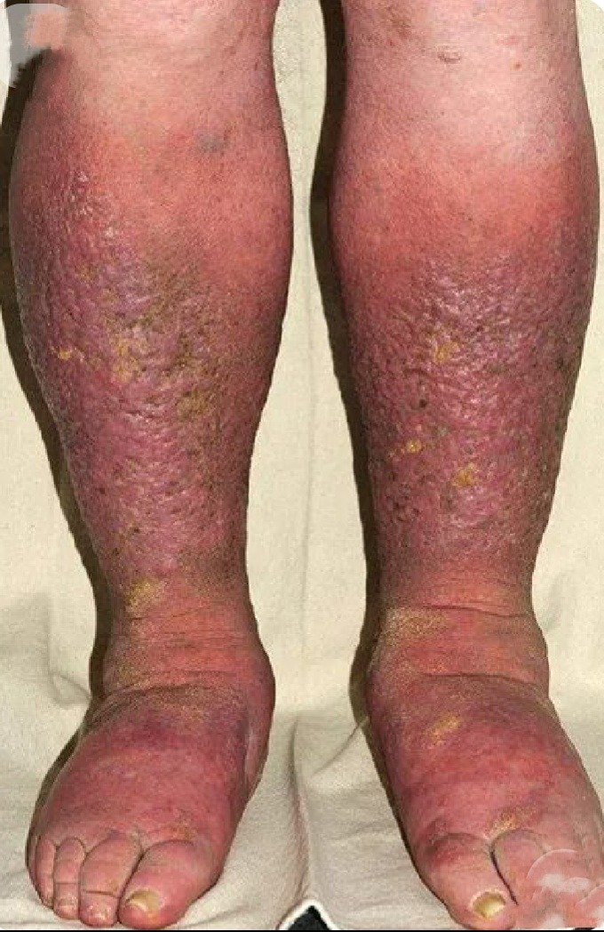 Stasis Dermatitis
