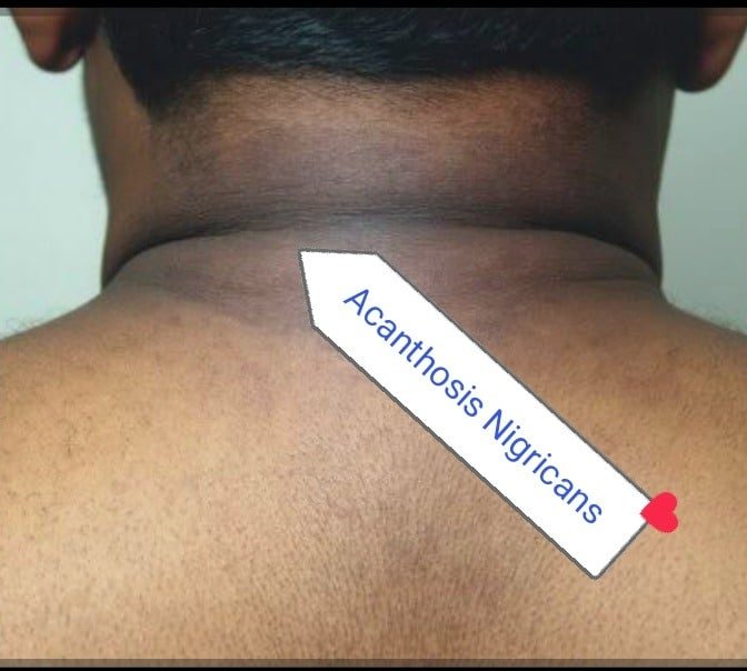 Acanthosis Nigricans