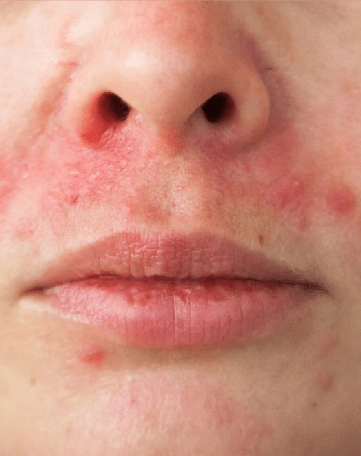 Perioral Dermatitis