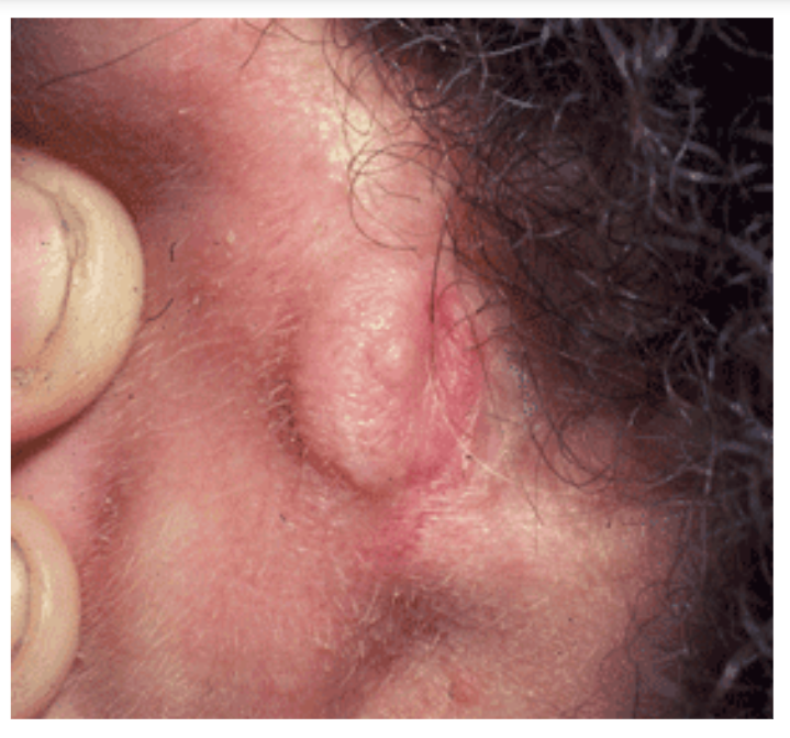 Acanthoma Fissuratum