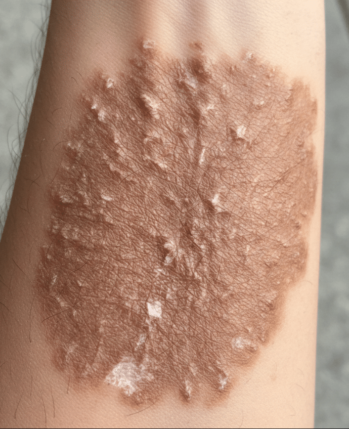 LICHEN SIMPLEX CHRONICUS (LSC)