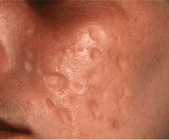 Acne Excoriée