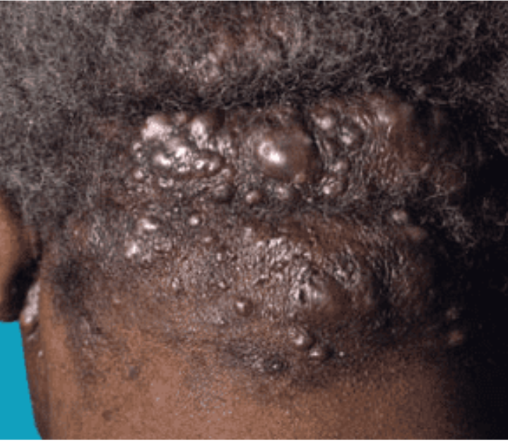 Acne Keloidalis Nuchae