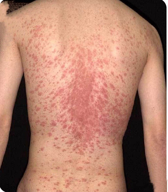 Pityriasis Rosea