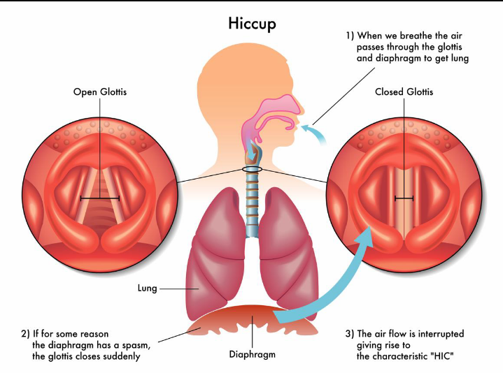 Hiccups