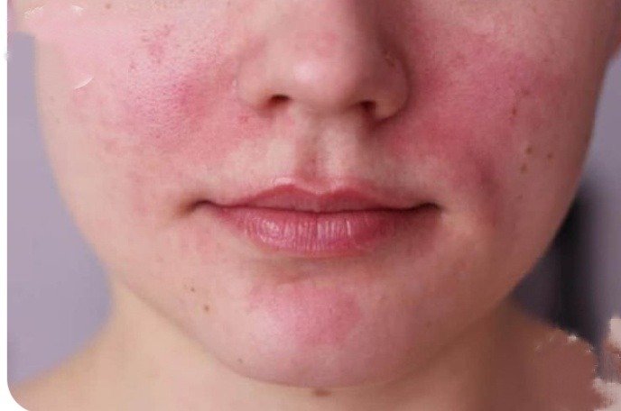 Pityriasis Rosacea