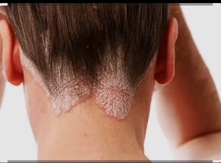 PSORIASIS