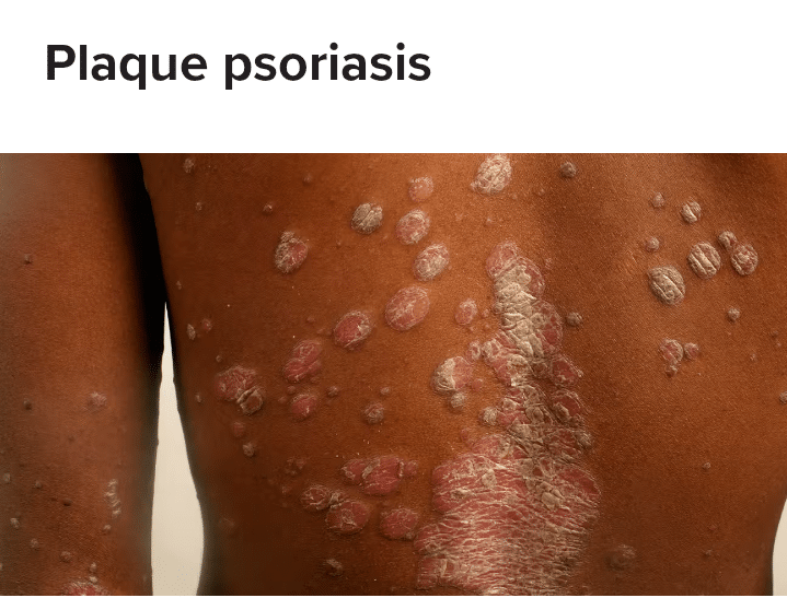 Plaque Psoriasis