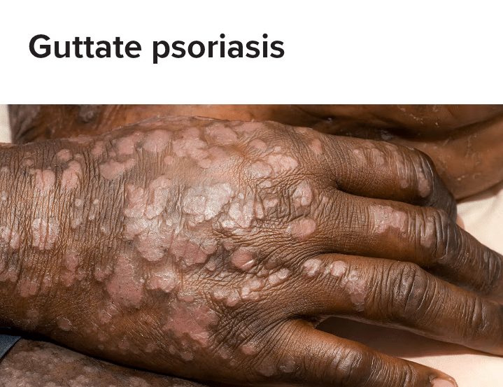 Guttate Psoriasis