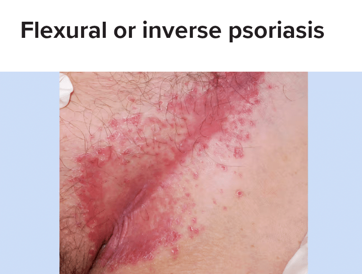 Flexural (Inverse) Psoriasis