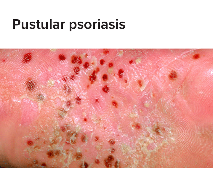 Pustular Psoriasis