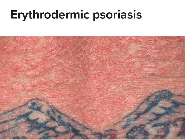 Erythrodermic Psoriasis