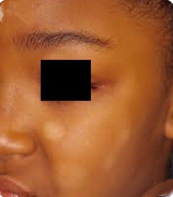 Pityriasis Alba