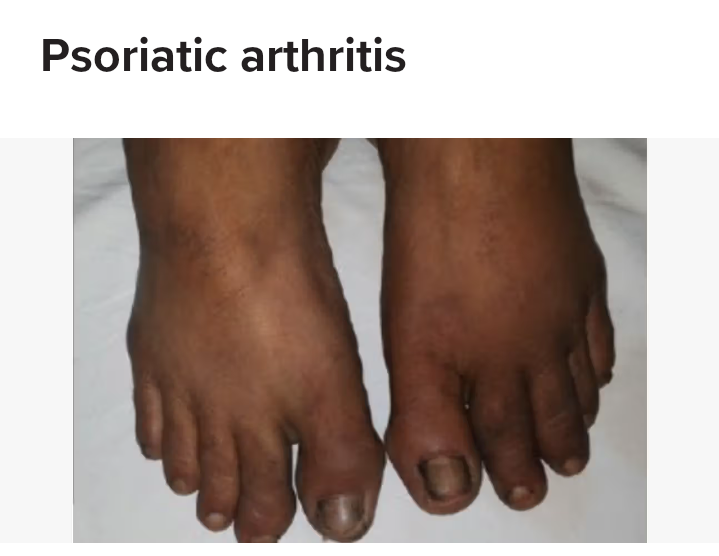 Psoriatic Arthritis