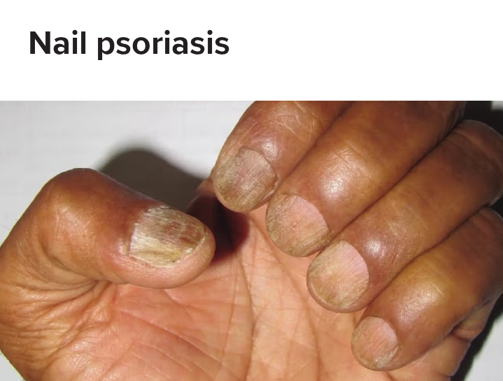 Nail Psoriasis