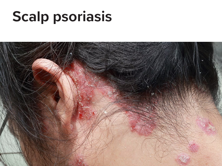Scalp Psoriasis