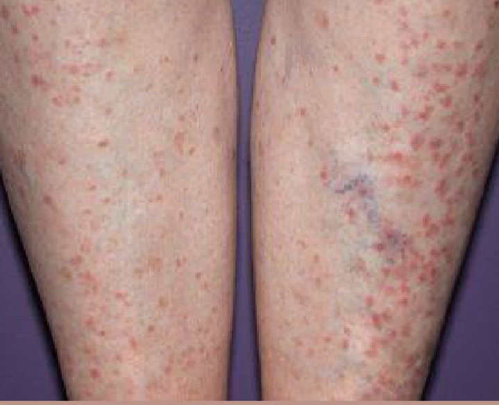 Lichen Planus