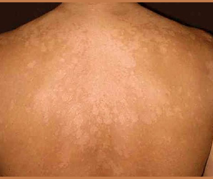 Pityriasis Versicolor