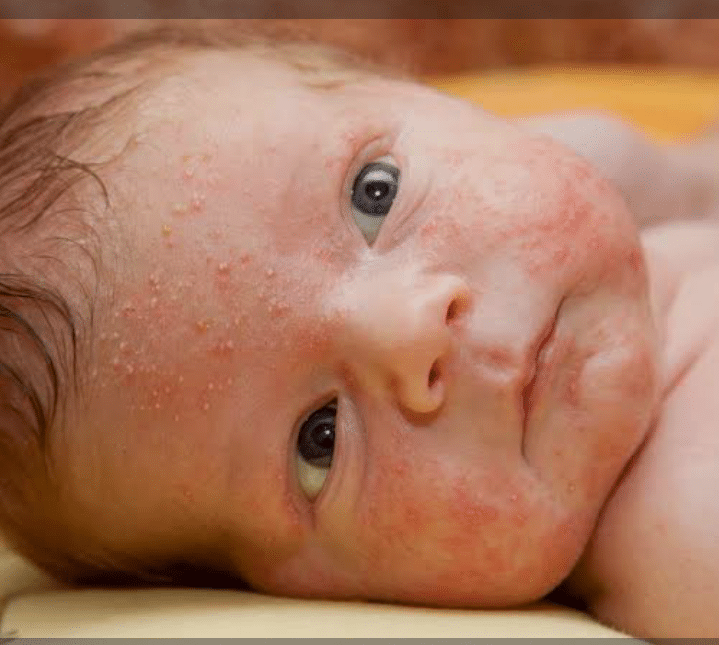 Neonatal Acne (Baby Acne)