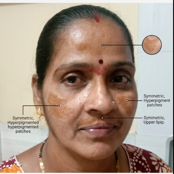 Melasma