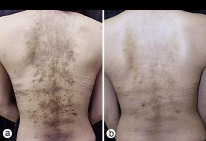 Hyperpigmentation and Methylcobalamin (Vitamin B12) Deficiency