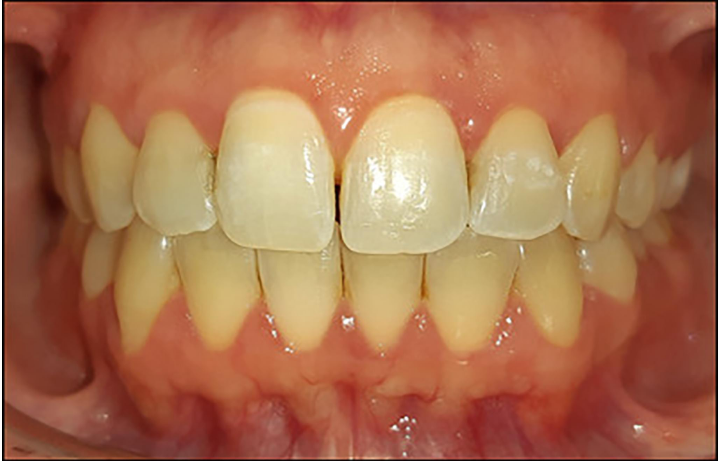 Scurvy and Ascorbic Acid (Vitamin C) Deficiency