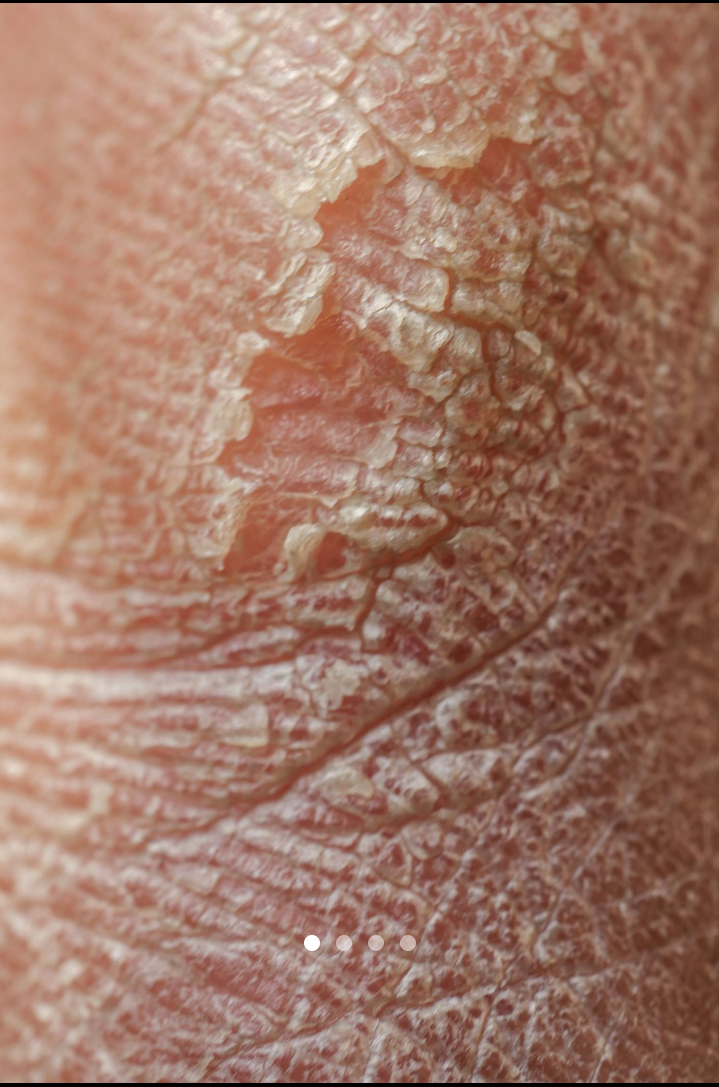 Rough Skin