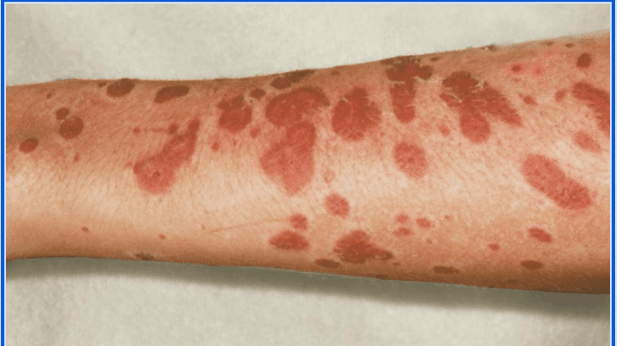 Stevens-Johnson Syndrome (SJS)