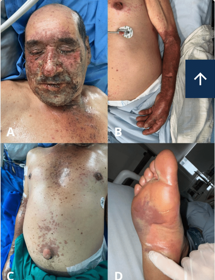 Toxic Epidermal Necrolysis
