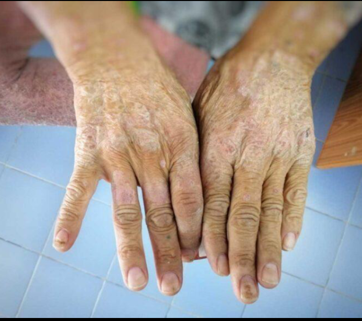 Rhenoderma