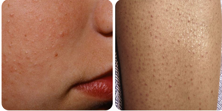 Follicular Hyperkeratosis (Small Rough Bumps) due to Vitamin A Deficiency