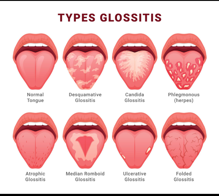Glossitis (Red Tongue)