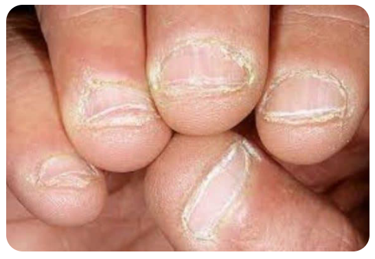 भंगुर नाखून (Brittle Nails)
