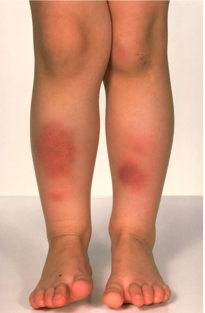 एरिथेमा नोडोसम (Erythema Nodosum)