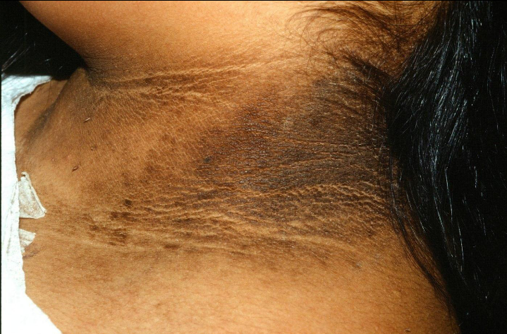 Acanthosis Nigricans