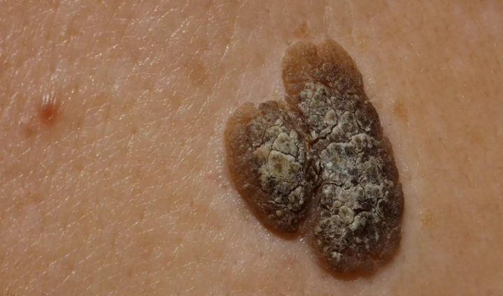 Cutaneous Neoplasms and Hyperplasias: An Overview