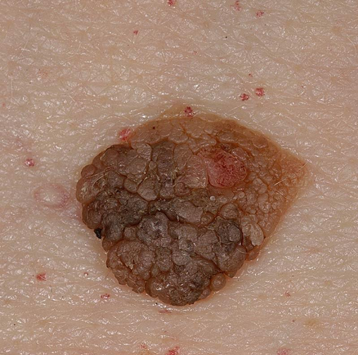Seborrheic Keratosis