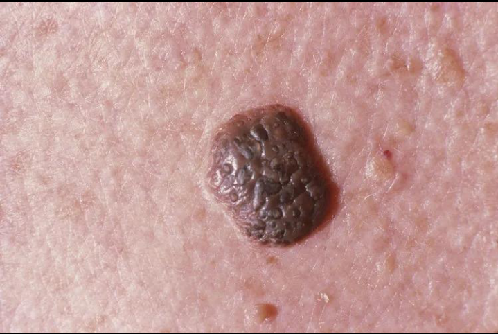 सेबोरिक केराटोसिस (Seborrheic Keratosis)