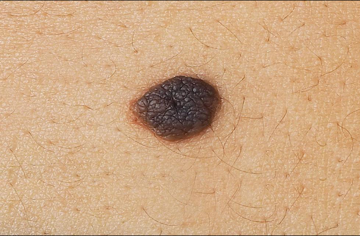 Melanocytic Nevus (Mole)