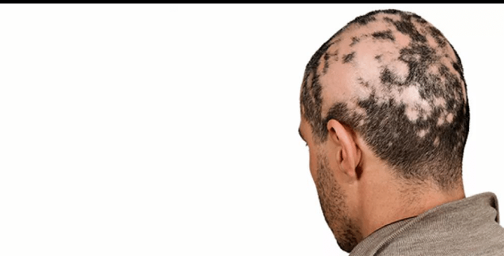 एलोपेसिया एरियाटा (Alopecia Areata)