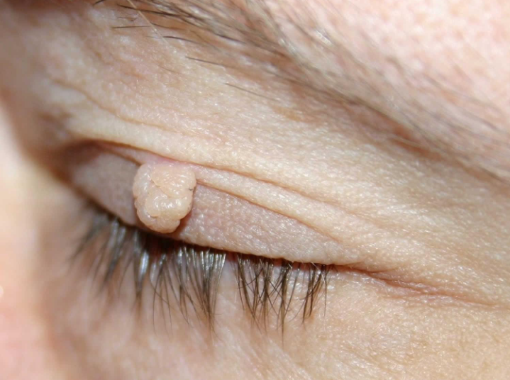 Skin Tags (Acrochordons)