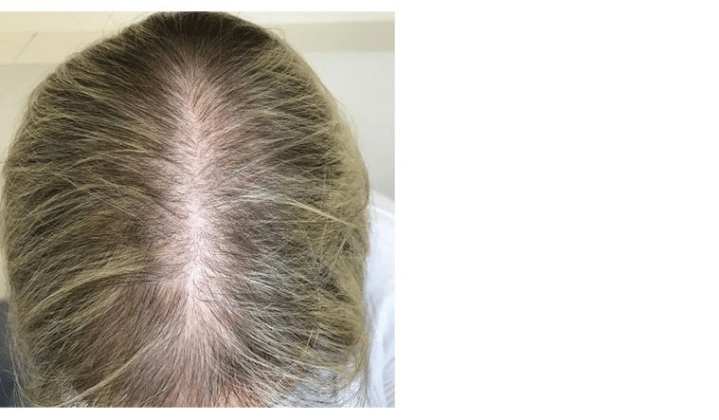 Androgenetic Alopecia (Male & Female Pattern Hair Loss)