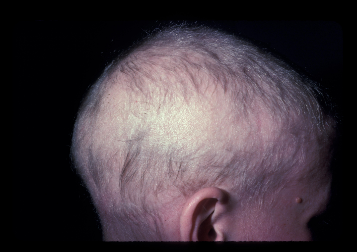 Alopecia Totalis